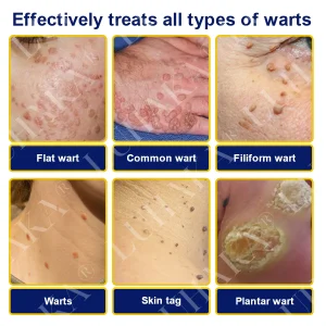 LUHAKA® SKIN TAG CRYO TREATMENT SPRAY ACE 13 LUHAKA® SKIN TAG CRYO TREATMENT SPRAY ACE