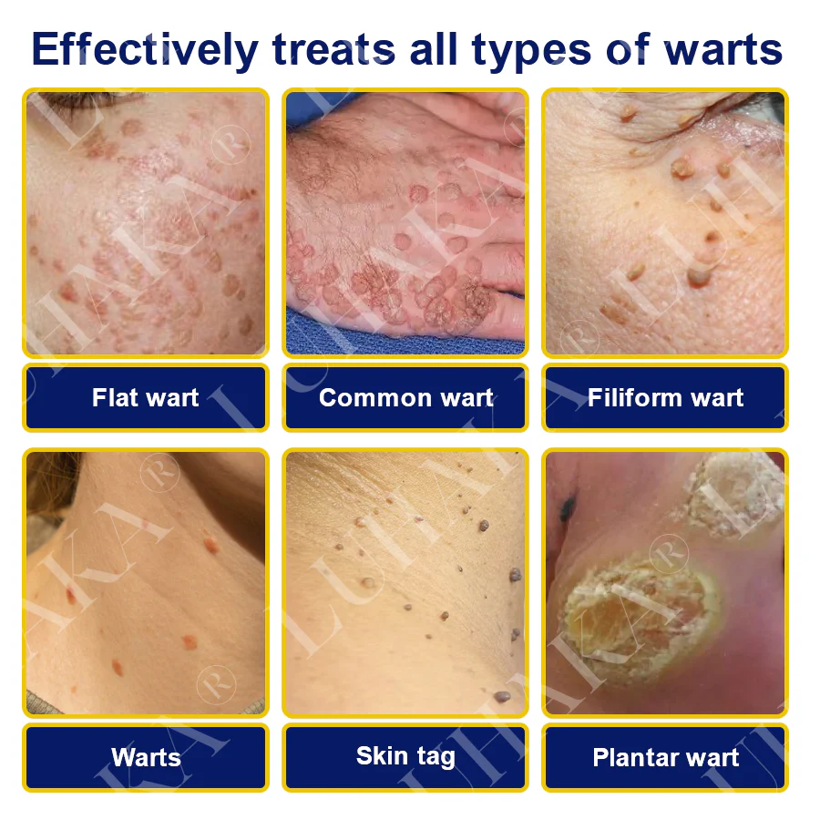 LUHAKA® SKIN TAG CRYO TREATMENT SPRAY ACE 5 LUHAKA® SKIN TAG CRYO TREATMENT SPRAY ACE