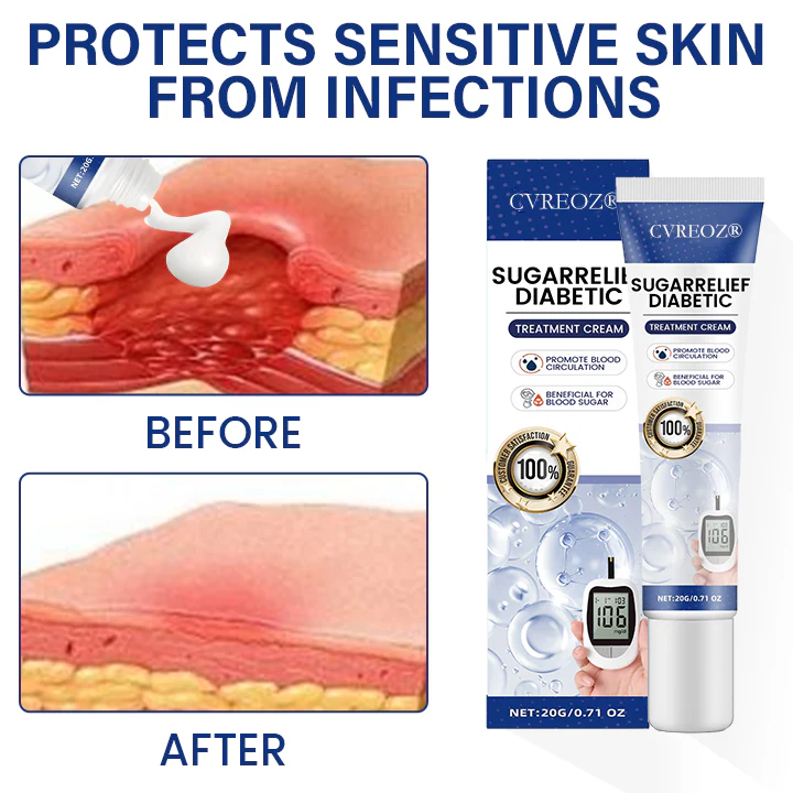 Cvreoz® SugarRelief Diabetic Treatment Cream 2 Cvreoz® SugarRelief Diabetic Treatment Cream