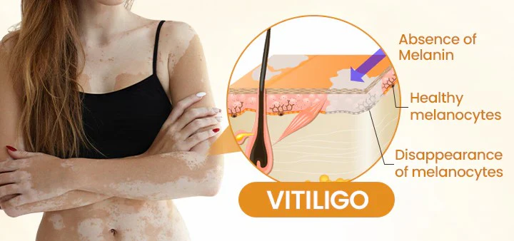 Newyuo® VitiCalm Bee Venom Cream 10 Newyuo® VitiCalm Bee Venom Cream