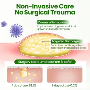 Cvreoz® KnotAway Lipoma Removal Cream 10 Cvreoz® KnotAway Lipoma Removal Cream