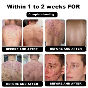 NESLEMY™ Psoriasis Cure Cream, relieves itching and restores smooth and youthful skin 13 NESLEMY™ Psoriasis Cure Cream, relieves itching and restores smooth and youthful skin