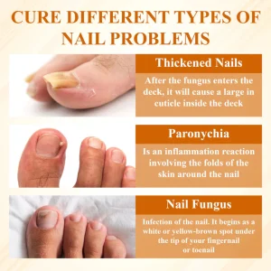 BBOJI® Fungiclear Bee Therapy Nail Spray 18 BBOJI® Fungiclear Bee Therapy Nail Spray