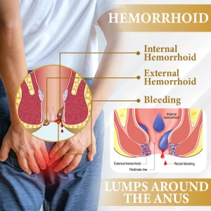 ATTDX® Apis Venom Hemorrhoid Cooling Spray 12 ATTDX® Apis Venom Hemorrhoid Cooling Spray