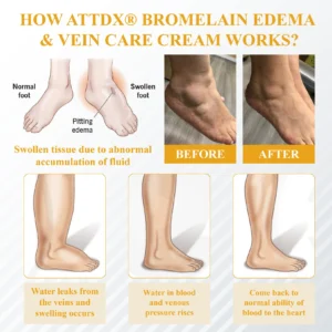 ATTDX® Bromelain Edema & Vein Care Cream 17 ATTDX® Bromelain Edema & Vein Care Cream