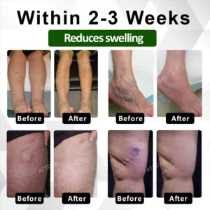 ATTDX® ClearCirculate Soursop Edema Detox Drops 15 ATTDX® ClearCirculate Soursop Edema Detox Drops