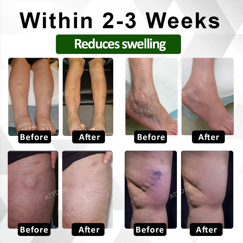 ATTDX® ClearCirculate Soursop Edema Detox Drops 3 ATTDX® ClearCirculate Soursop Edema Detox Drops - Image 3