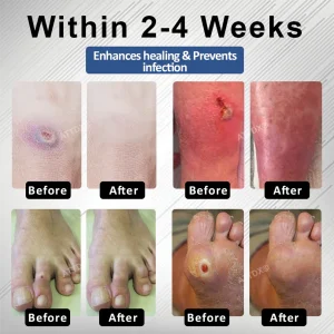 CVREOZ® Diabetes Foot Guard Fast Recovery Spray 14 CVREOZ® Diabetes Foot Guard Fast Recovery Spray