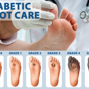 CVREOZ® Diabetes Foot Guard Fast Recovery Spray 19 CVREOZ® Diabetes Foot Guard Fast Recovery Spray