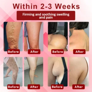 ATTDX® EdemaCare Lymphatic Drainage Massage Cream