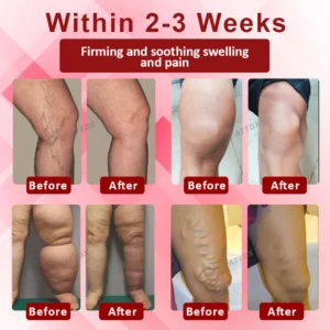 ATTDX® EdemaCare Lymphatic Drainage Massage Cream