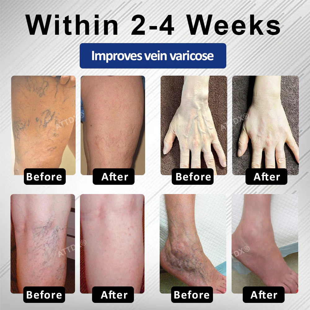 ATTDX® MagniLift VeinErase Spray 3 ATTDX® MagniLift VeinErase Spray - Image 3