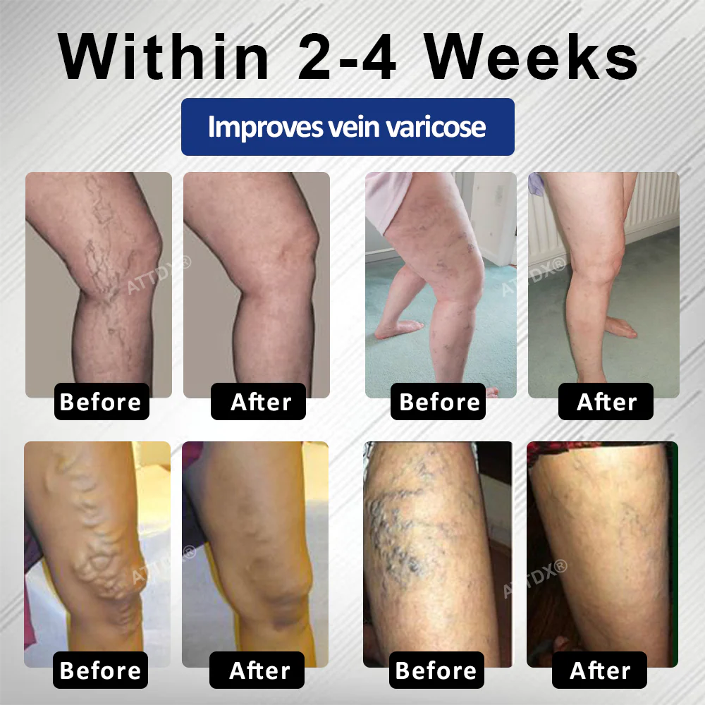 ATTDX® MagniLift VeinErase Spray 2 ATTDX® MagniLift VeinErase Spray