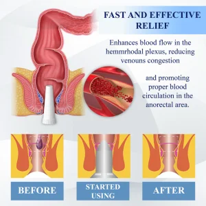 ATTDX® Medical Hemorrhoid Herbal Gel with Applicator 11 ATTDX® Medical Hemorrhoid Herbal Gel with Applicator