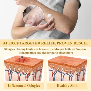 ATTDX® NervoSoothe Shingles Healing Ointment 15 ATTDX® NervoSoothe Shingles Healing Ointment