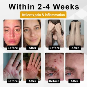 ATTDX® NervoSoothe Shingles Healing Ointment 11 ATTDX® NervoSoothe Shingles Healing Ointment