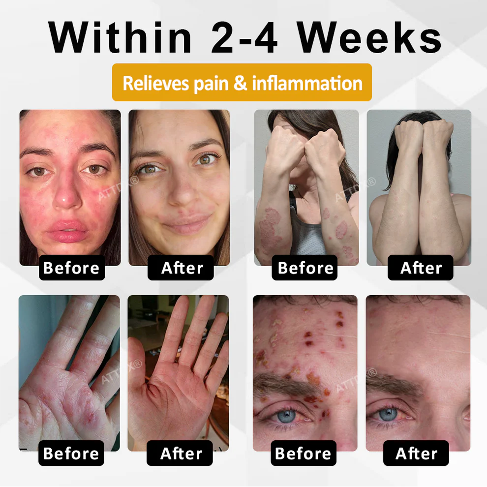 ATTDX® NervoSoothe Shingles Healing Ointment 2 ATTDX® NervoSoothe Shingles Healing Ointment