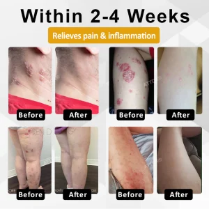 ATTDX® NervoSoothe Shingles Healing Ointment 12 ATTDX® NervoSoothe Shingles Healing Ointment