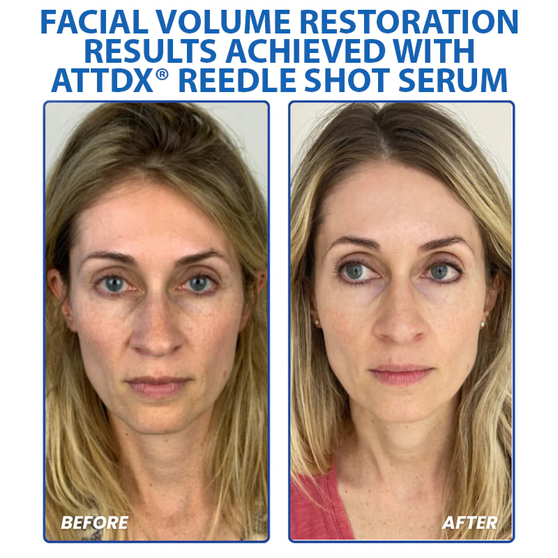 ATTDX® PDRN-NAD+ Cica Reedle Shot Serum 5 ATTDX® PDRN-NAD+ Cica Reedle Shot Serum - Image 5