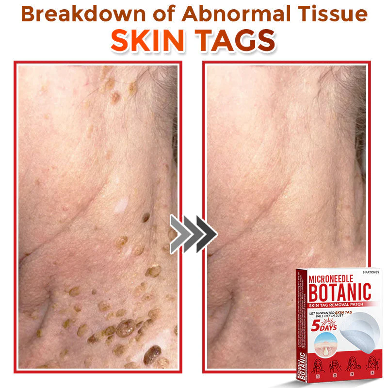LOVILDS® MicroNeedle Botanic Skin Tag Removal Patch 7 LOVILDS® MicroNeedle Botanic Skin Tag Removal Patch - Image 7