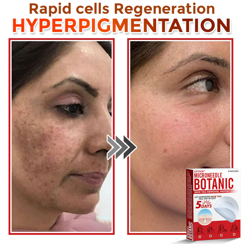 GFOUK® MicroNeedle Botanic Skin Tag Removal Patch 8 GFOUK® MicroNeedle Botanic Skin Tag Removal Patch