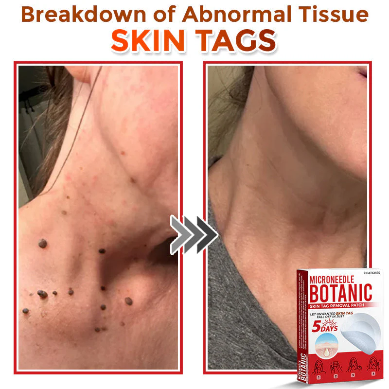 LOVILDS® MicroNeedle Botanic Skin Tag Removal Patch 5 LOVILDS® MicroNeedle Botanic Skin Tag Removal Patch