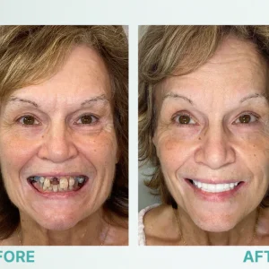 Zynutra Snap-on Teeth Veneers 11 Zynutra Snap-on Teeth Veneers