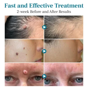 Alisanda™ LumeSkin Mole and Wart Removal Laser Pen