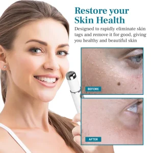 Alisanda™ LumeSkin Mole and Wart Removal Laser Pen