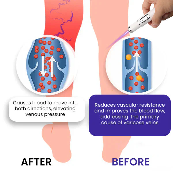 Bikenda® Varicose Vein Photothermal Laser Treatment 5 Bikenda® Varicose Vein Photothermal Laser Treatment