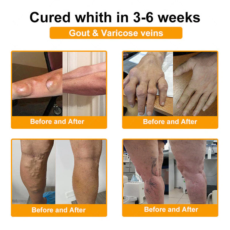 ADFIRE® Bee Venom Pain-Relief Bone Healing Spray 5 ADFIRE® Bee Venom Pain-Relief Bone Healing Spray