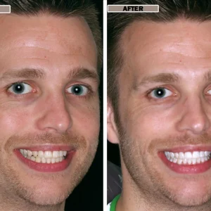 NESLEMY™Coconut Whitening Strips 20 NESLEMY™Coconut Whitening Strips