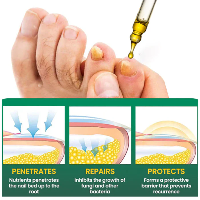 AEXZR® Fungal Nail Treatment 3 AEXZR® Fungal Nail Treatment