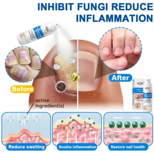 HZA™ Magnesium Herbal Psoriasis Spray 17 HZA™ Magnesium Herbal Psoriasis Spray