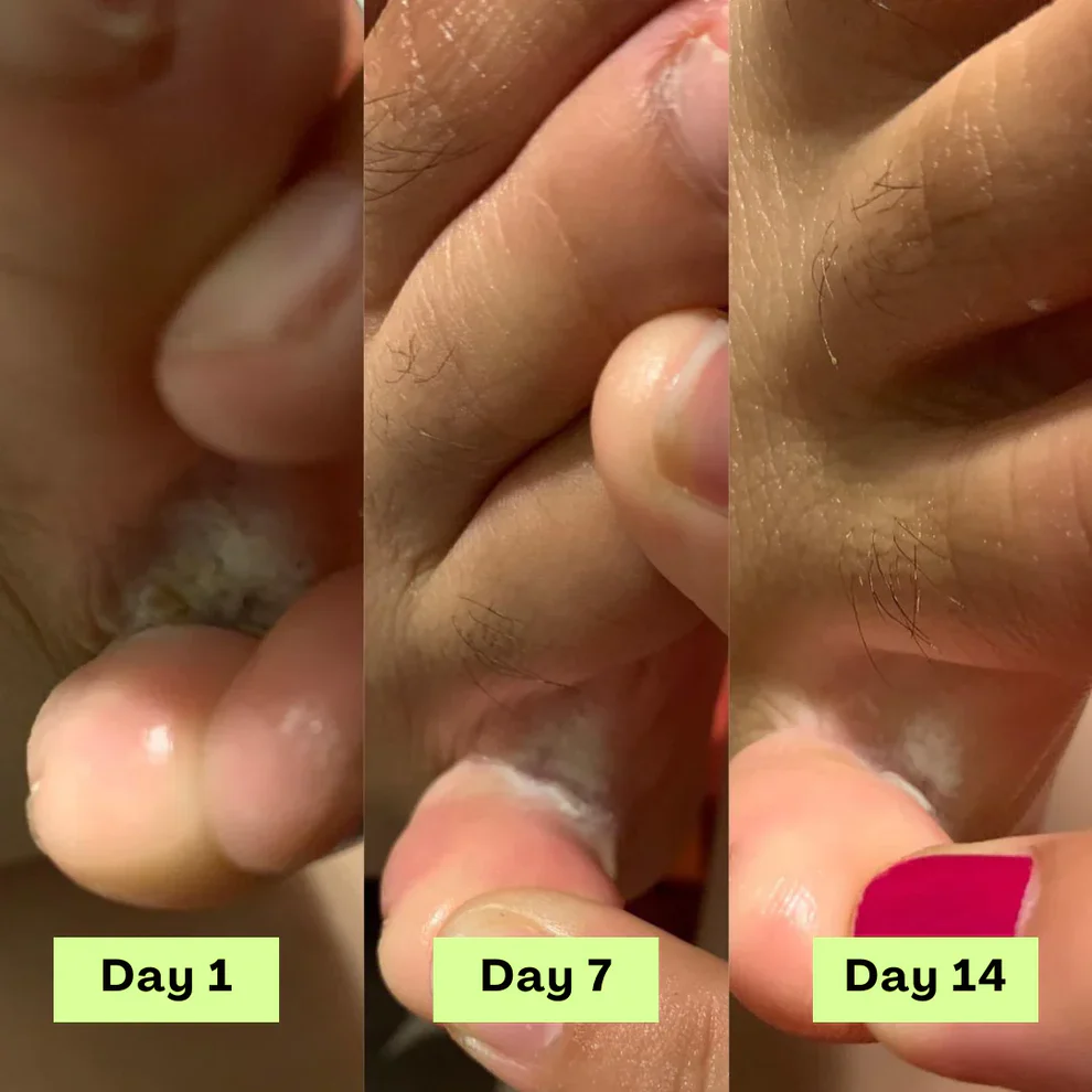 NEGUSY™ Tea Tree Athlete's Foot Defense Soap 8 NEGUSY™ Tea Tree Athlete's Foot Defense Soap