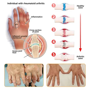 Jorondy® Bee Venom Pain-Relief Bone Healing Spray 39 Jorondy® Bee Venom Pain-Relief Bone Healing Spray