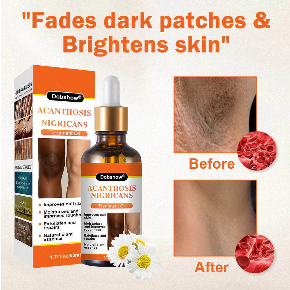 Dobshow® Acanthosis Nigricans Treatment Oil 3 Dobshow® Acanthosis Nigricans Treatment Oil