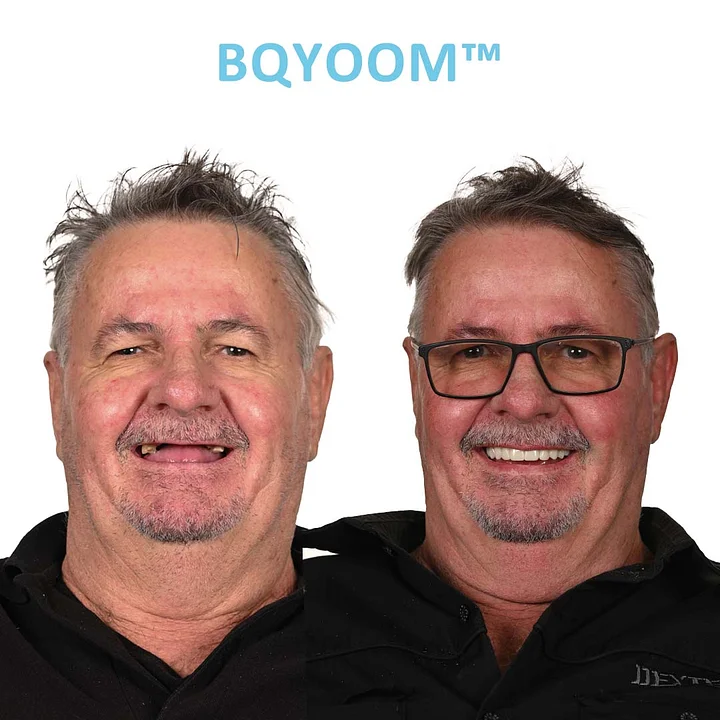 BQYOOM™ Dentures | Invisible Comfort, Natural Grip 5 BQYOOM™ Dentures | Invisible Comfort, Natural Grip