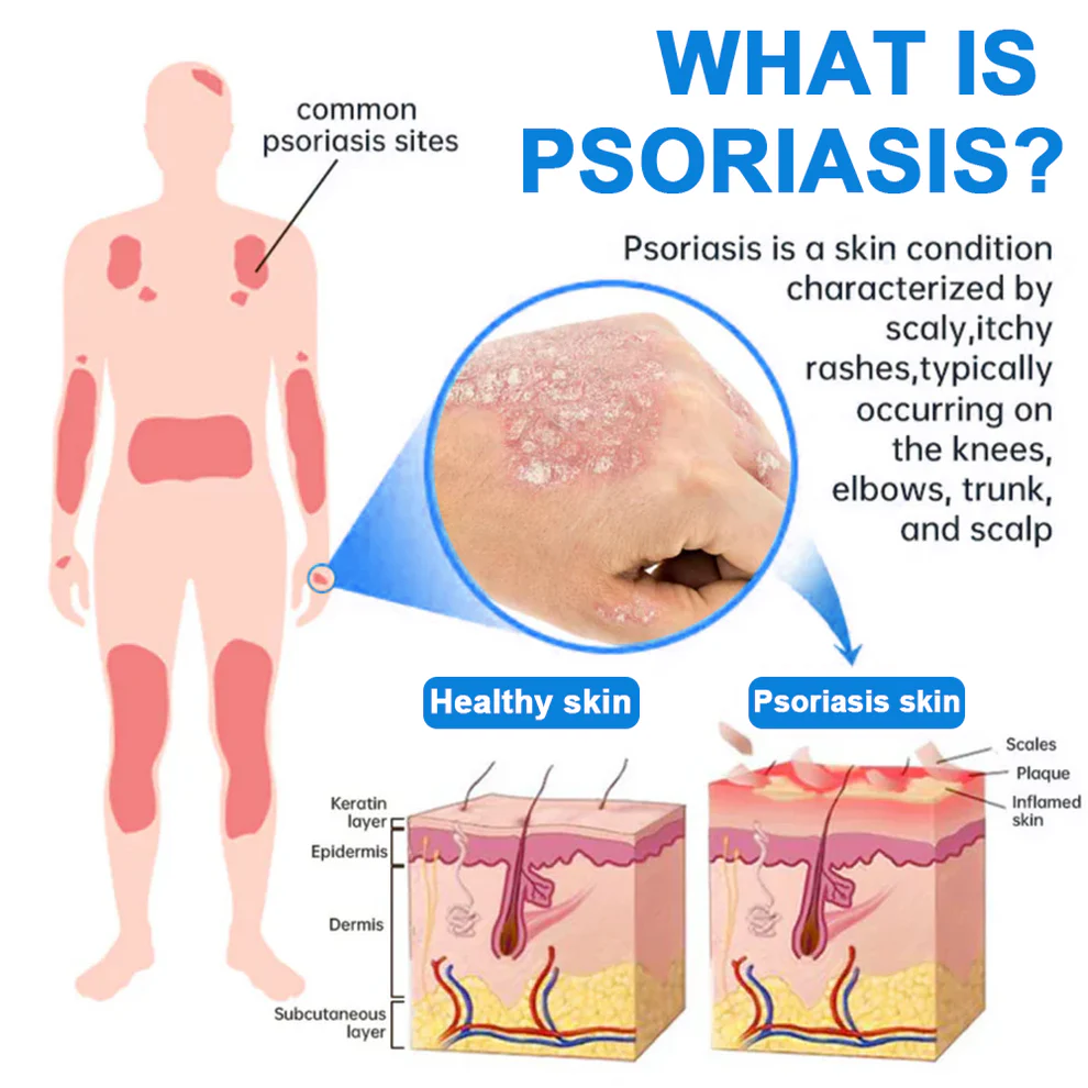 Zvoevo®Magnesium Herbal Psoriasis Spray 2 Zvoevo®Magnesium Herbal Psoriasis Spray