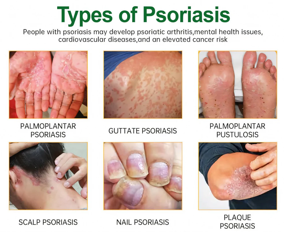 Cvreoz® Knotaway Psoriasis Cream 3 Cvreoz® Knotaway Psoriasis Cream