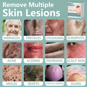 ODALIT™ MicroNeedle Botanic skin Tag Removal Patch 9 ODALIT™ MicroNeedle Botanic skin Tag Removal Patch