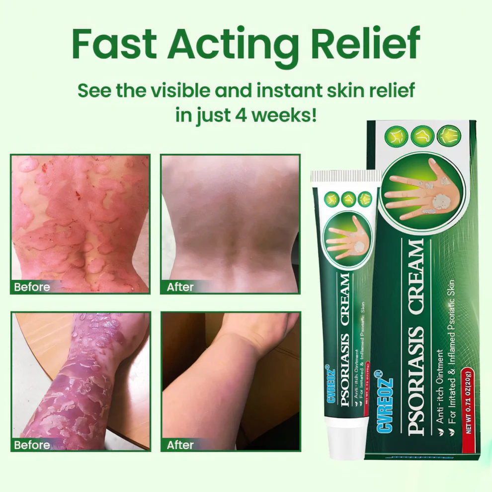 Cvreoz® Knotaway Psoriasis Cream 8 Cvreoz® Knotaway Psoriasis Cream