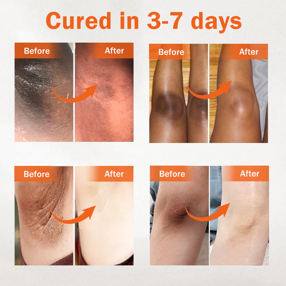 Dobshow® Acanthosis Nigricans Treatment Oil 6 Dobshow® Acanthosis Nigricans Treatment Oil