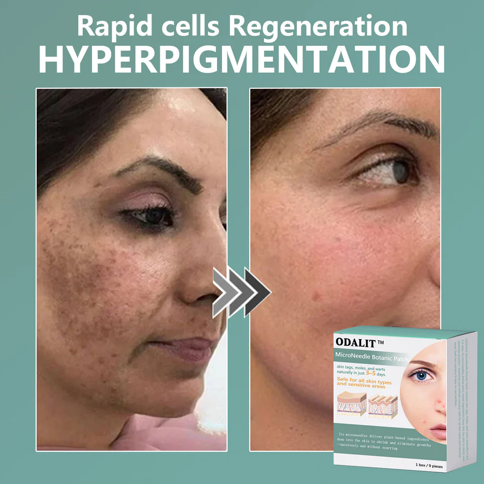 ODALIT™ MicroNeedle Botanic skin Tag Removal Patch 3 ODALIT™ MicroNeedle Botanic skin Tag Removal Patch