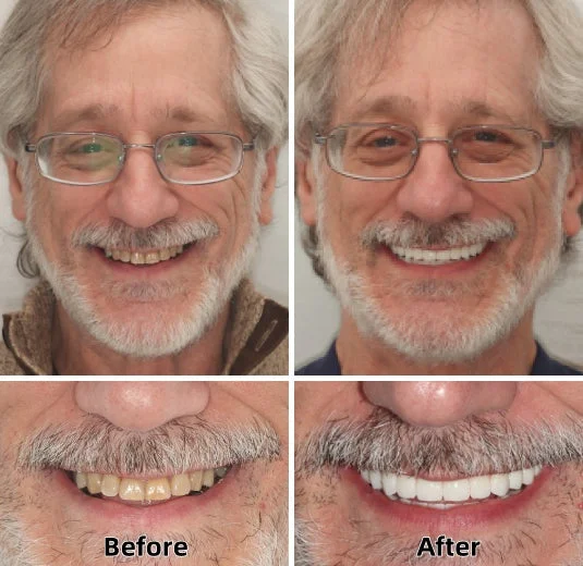 LAOZIK™-Advanced Custom-Fit Functional Dentures 4 LAOZIK™-Advanced Custom-Fit Functional Dentures - Image 4