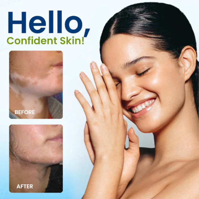 Cvreoz® Vitiligo Treatment Spray 2 Cvreoz® Vitiligo Treatment Spray