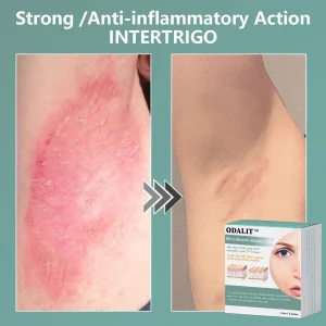 ODALIT™ MicroNeedle Botanic skin Tag Removal Patch 11 ODALIT™ MicroNeedle Botanic skin Tag Removal Patch