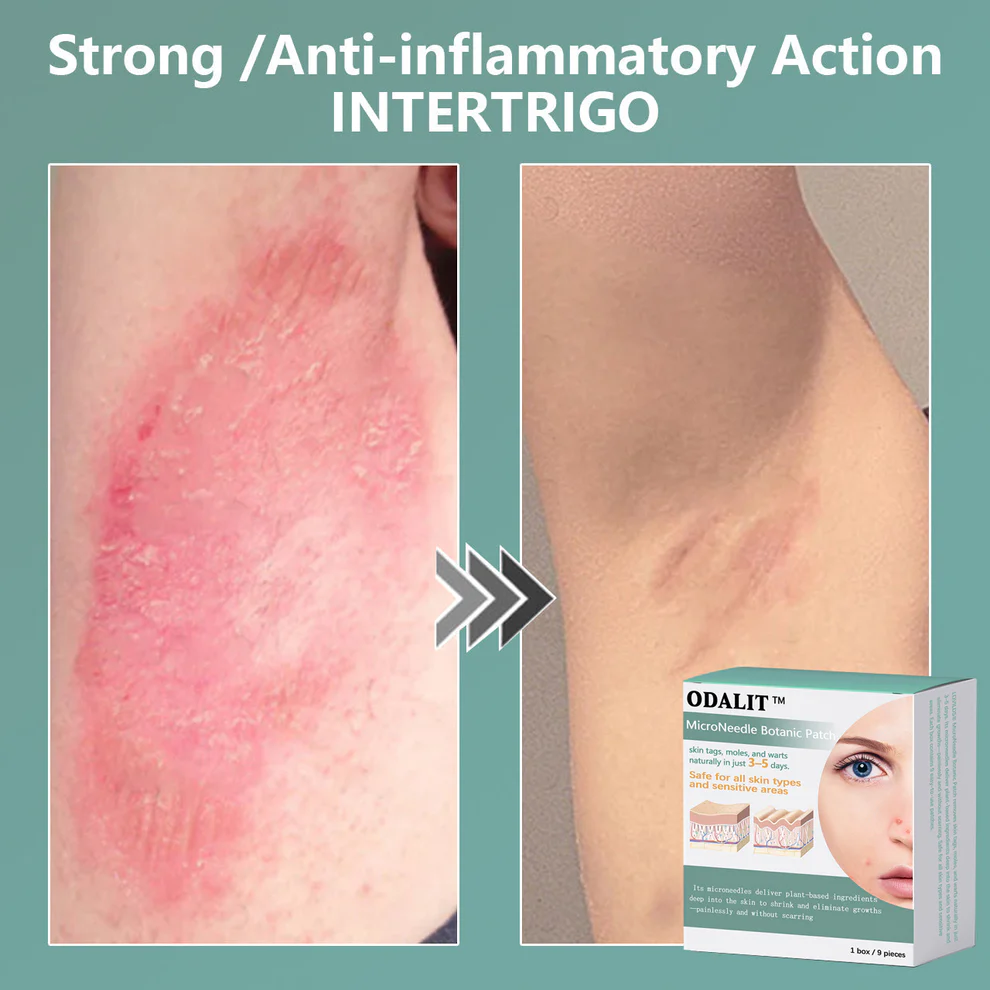 ODALIT™ MicroNeedle Botanic skin Tag Removal Patch 4 ODALIT™ MicroNeedle Botanic skin Tag Removal Patch