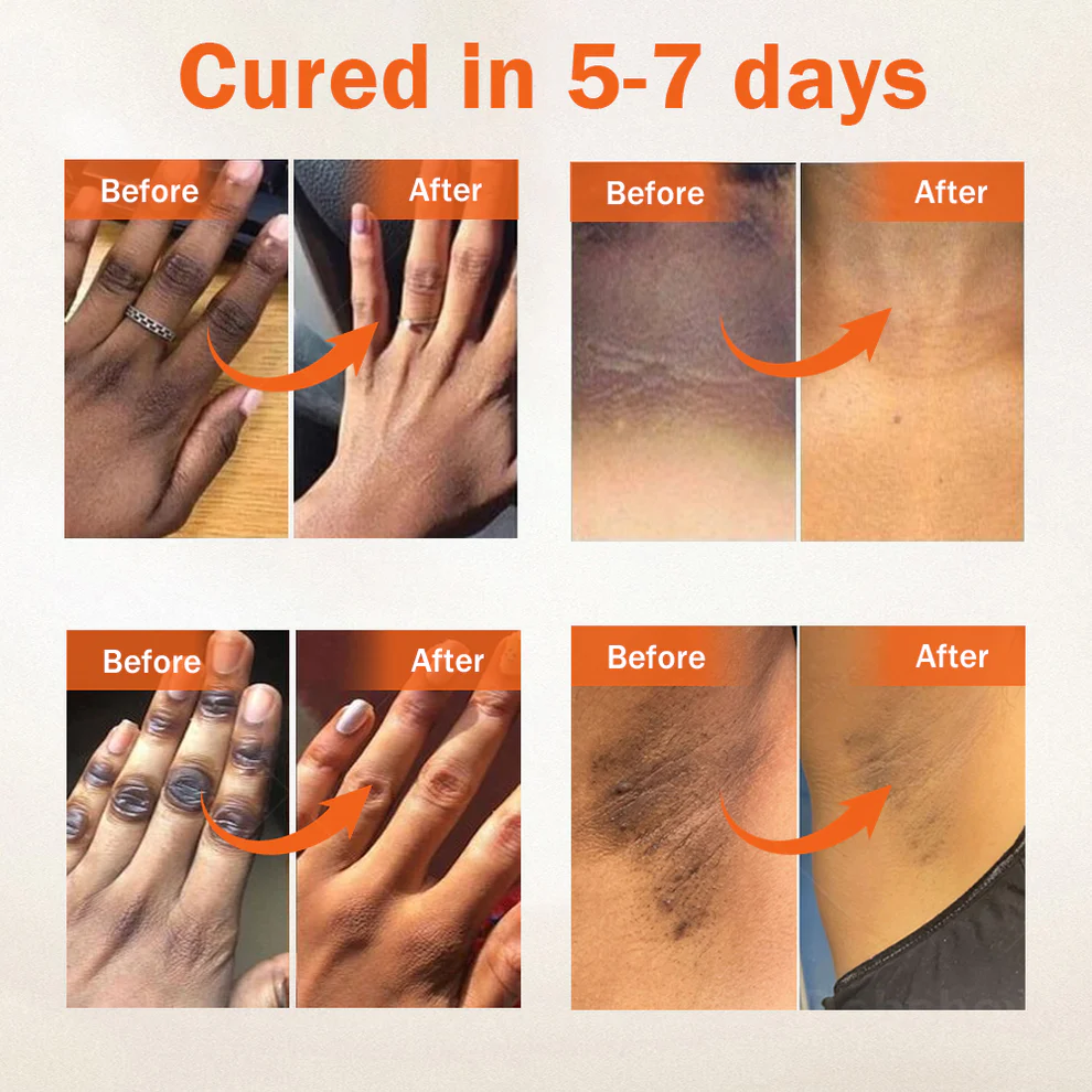 Dobshow® Acanthosis Nigricans Treatment Oil 7 Dobshow® Acanthosis Nigricans Treatment Oil