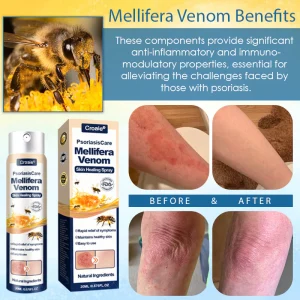 Croaie® PsoriasisCare Mellifera Venom Skin Healing Spray 23 Croaie® PsoriasisCare Mellifera Venom Skin Healing Spray